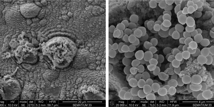 Антибактериални материали за медицински импланти